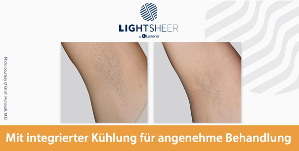 LightSheer QUATTRO Laserbehandlung - Ergebnis